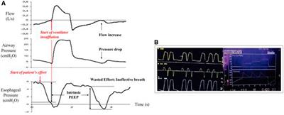 Optimizing Patient–Ventilator Synchrony Utilizing Radar-Based Respiratory Features for Monitoring COVID-19 Patients